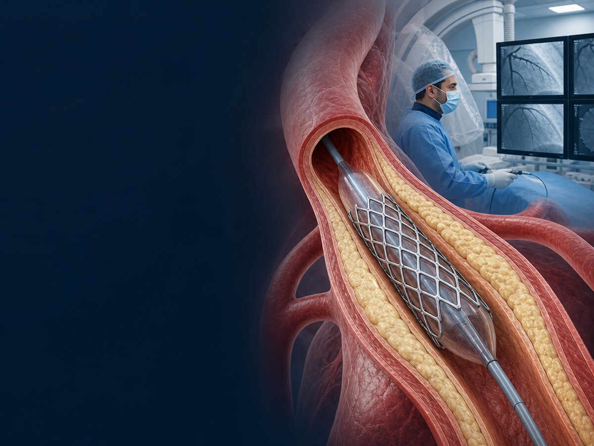 Koroner damarda balonla açılan stent iskeletinin damar duvarını desteklemesi